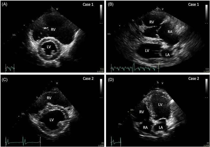 Case 1 Echocardiogram