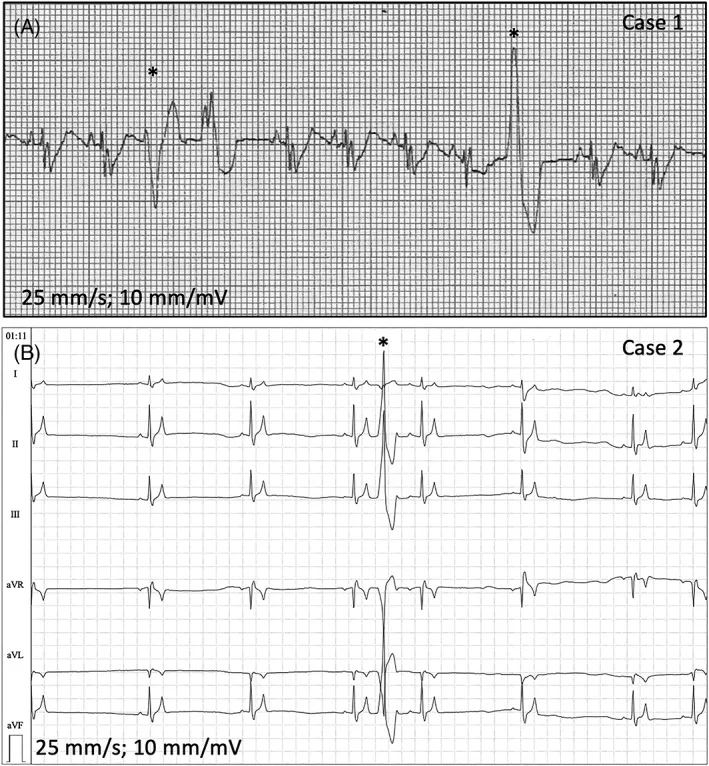Case 2 ECG