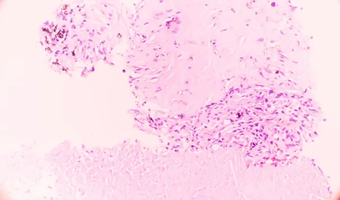 Microscopic view of a necrotic granuloma from human lung biopsy due to heartworm