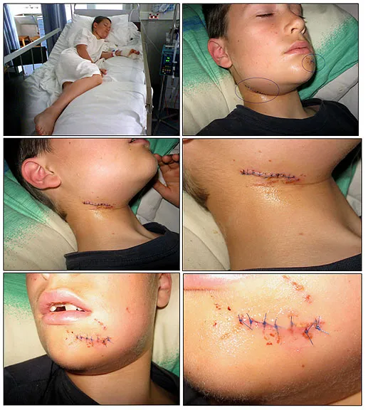 A close-up graphic image of a severe dog bite injury on a person's chin and neck area, showing lacerations and swelling.