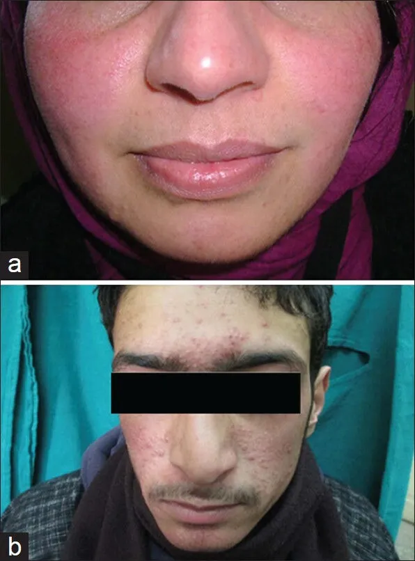 Clinical presentation of rosacea, a skin condition potentially exacerbated by Demodex mites