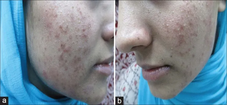 Facial dermatitis with redness and papules, a symptom that can be associated with Demodex proliferation