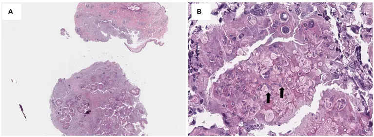 Histopathological view of dermis expanded by nodular inflammatory infiltrate with macrophages, neutrophils, lymphocytes, plasma cells, and central irregular fungal hyphae (H&E staining, 40x and 400x)