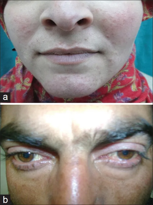 Patient exhibiting symptoms of peri-oral dermatitis, one of the diverse manifestations of mite-related skin issues